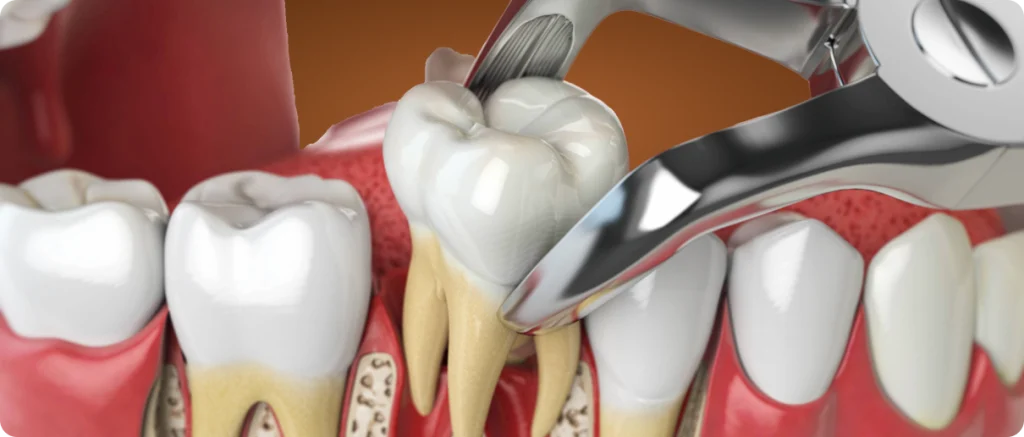 Extraction/implantation immédiate