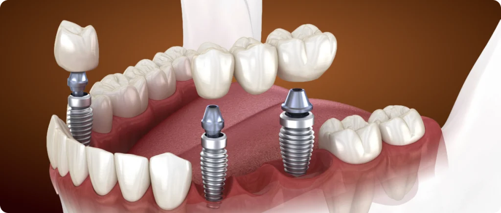 Couronnes et bridges sur implant