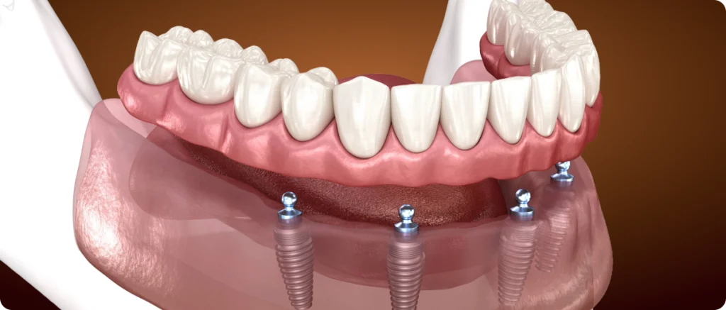 Prothèse amovible sur implant