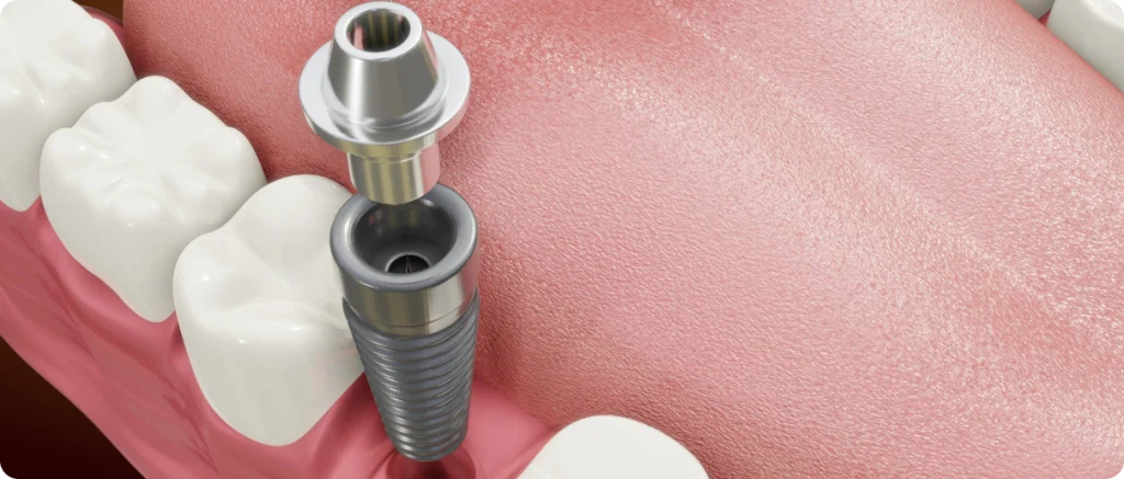 Mise en charge immédiate